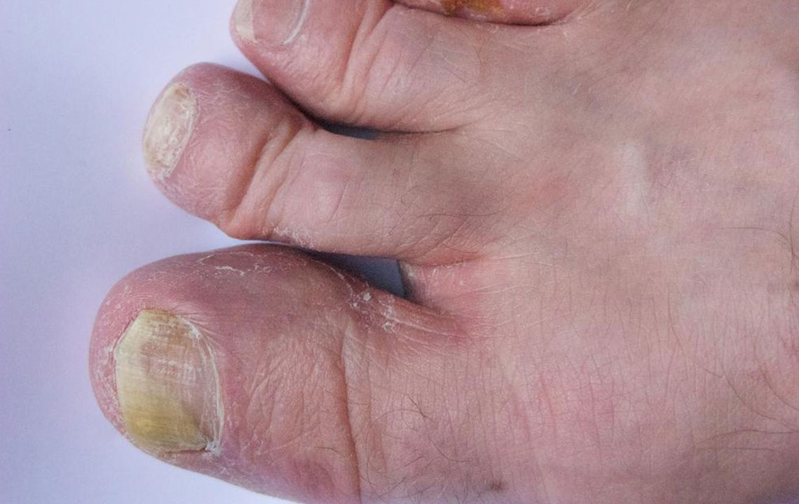 Guide to Treating Toenail Fungus