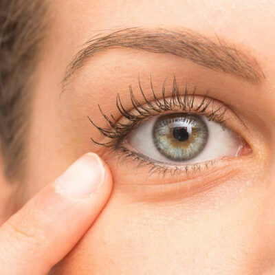How to Get Rid of Under Eye Bags Naturally