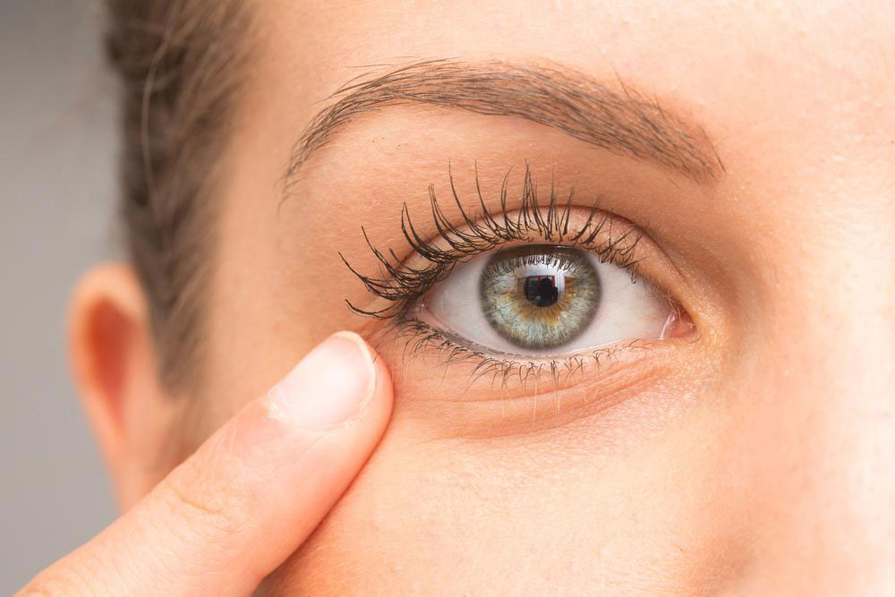 How to Get Rid of Under Eye Bags Naturally