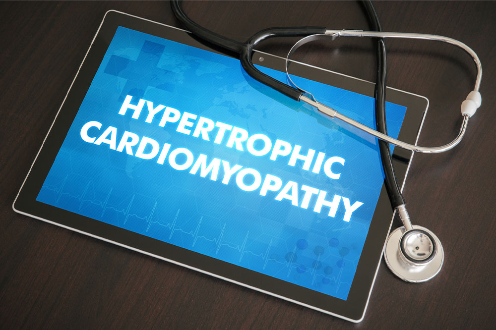 Everything to know about obstructive hypertrophic cardiomyopathy